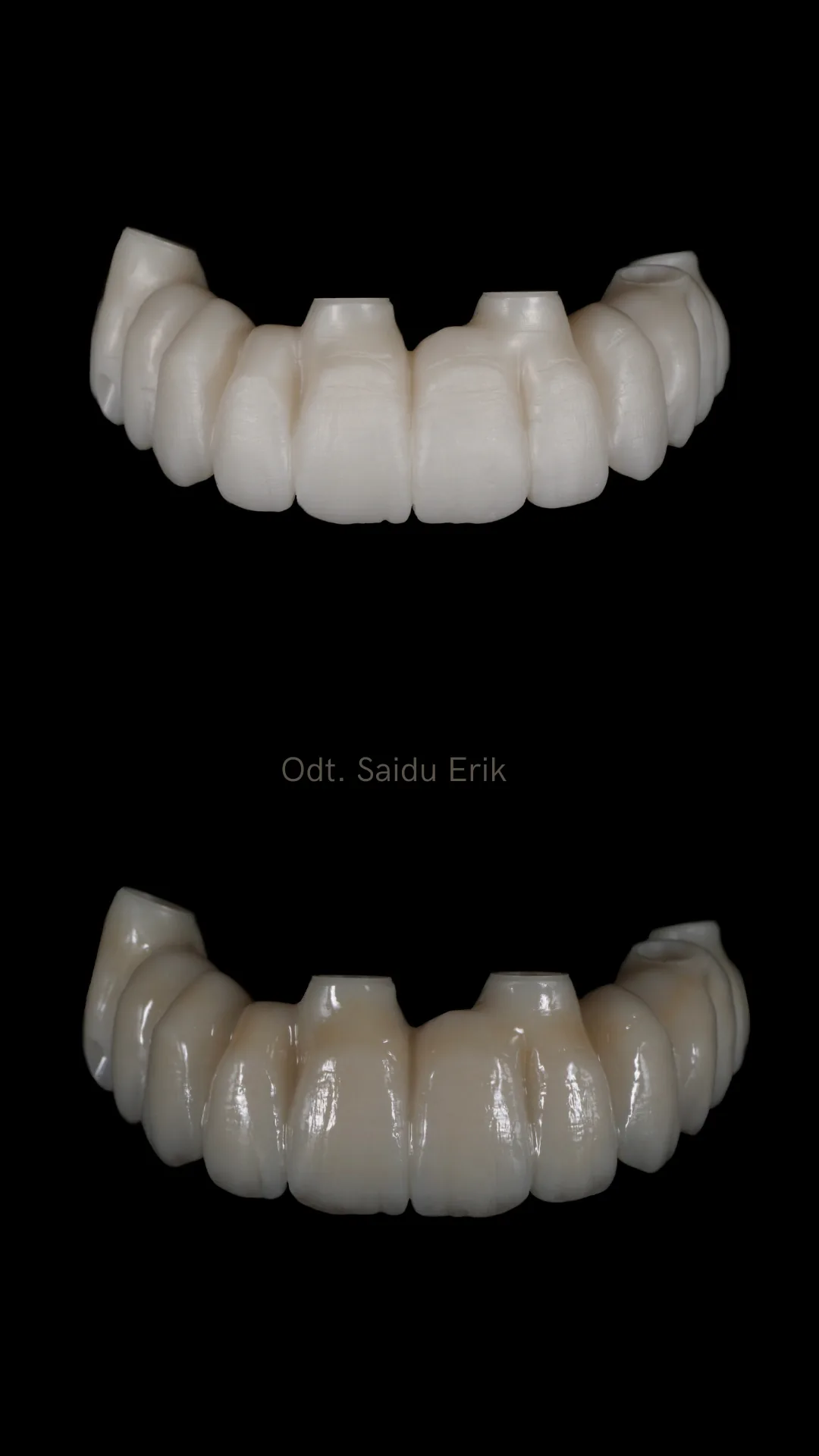 All on X in zirconia micro stratificata, caso 5: arcata superiore e inferiore su fondo nero
