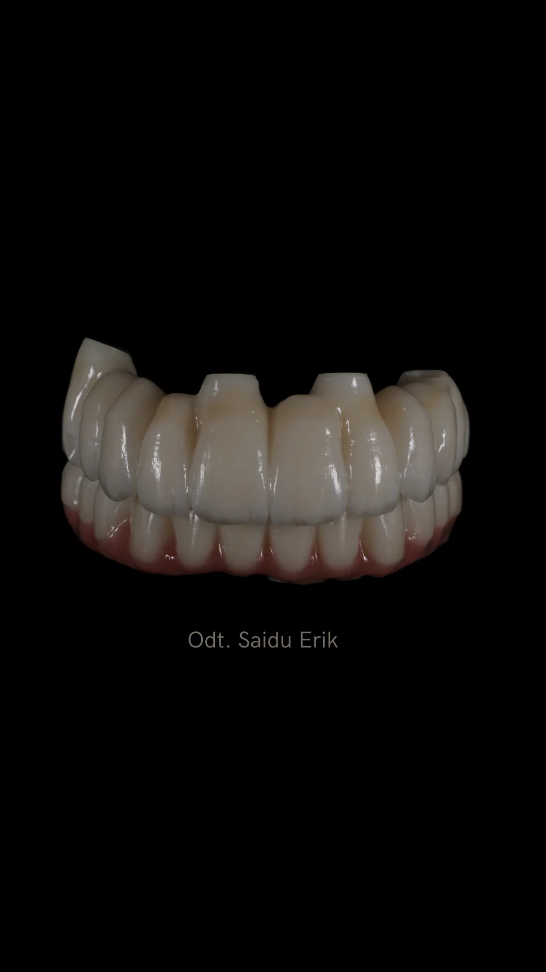 All on X in zirconia micro stratificata, caso 6: arcata superiore e inferiore su fondo nero