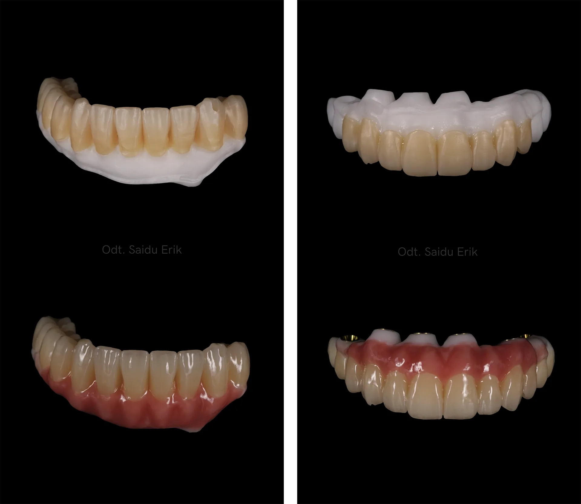 Le due arcate su impianti in zirconia su zirconia, in quattro viste