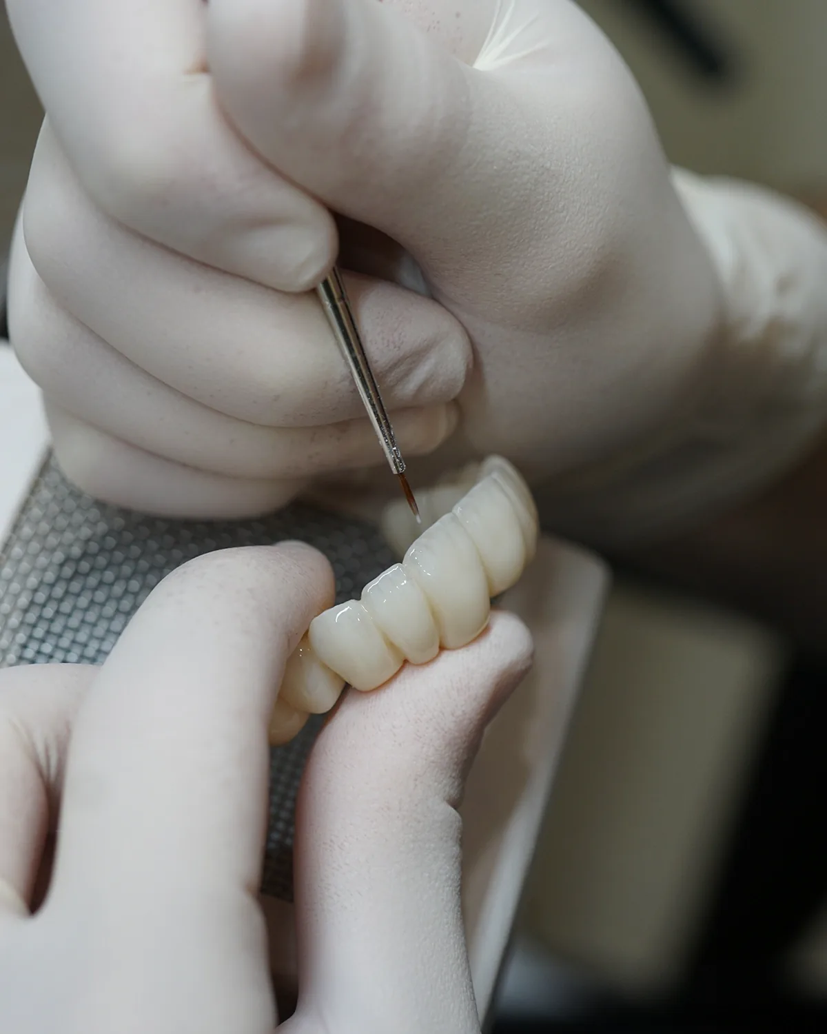 Rifinitura a mano di una protesi fissa, con lo strumento tra le dita guantate